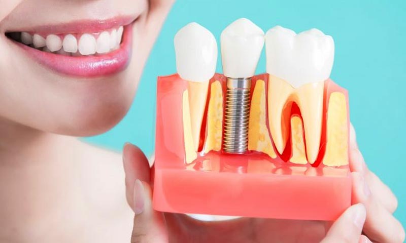dental implants requirements