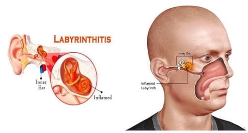 What is Labyrinthitis